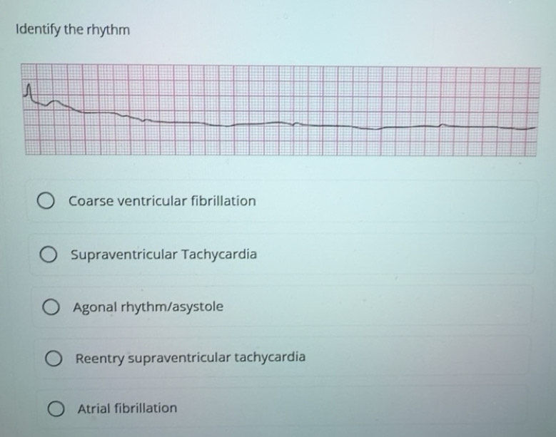 Solved: Identify the rhythm Coarse ventricular fibrillation ...