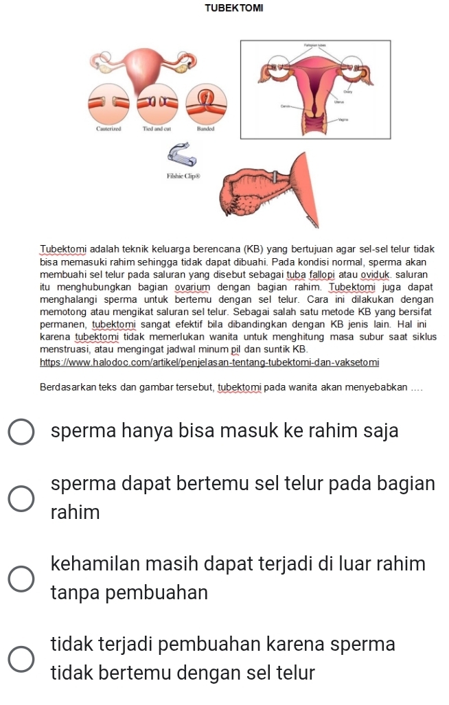 TUBEKTOMI
Tubektomi adalah teknik keluarga berencana (KB) yang bertujuan agar sel-sel telur tidak
bisa memasuki rahim sehingga tidak dapat dibuahi. Pada kondisi normal, sperma akan
membuahi sel telur pada saluran yang disebut sebagai tuba fallopi atau oviduk. saluran
itu menghübungkan bagian ovarium dengan bagian rahim. Tubektomi juga dapat
menghalangi sperma untuk bertemu dengan sel telur. Cara ini dilakukan dengan
memotong atau mengikat saluran sel telur. Sebagai salah satu metode KB yang bersifat
permanen, tubektomi sangat efektif bila dibandingkan dengan KB jenis lain. Hal ini
karena tubektomi tidak memerlukan wanita untuk menghitung masa subur saat siklus
menstruasi, atau mengingat jadwal minum pil dan suntik KB.
https ://www.h alo do c. com/artikel/penjelas an-tentang-tubektomi-dan-vakseto mi
Berdasarkan teks dan gambar tersebut, tubektomi pada wanita akan menyebabkan ....
sperma hanya bisa masuk ke rahim saja
sperma dapat bertemu sel telur pada bagian
rahim
kehamilan masih dapat terjadi di luar rahim
tanpa pembuahan
tidak terjadi pembuahan karena sperma
tidak bertemu dengan sel telur