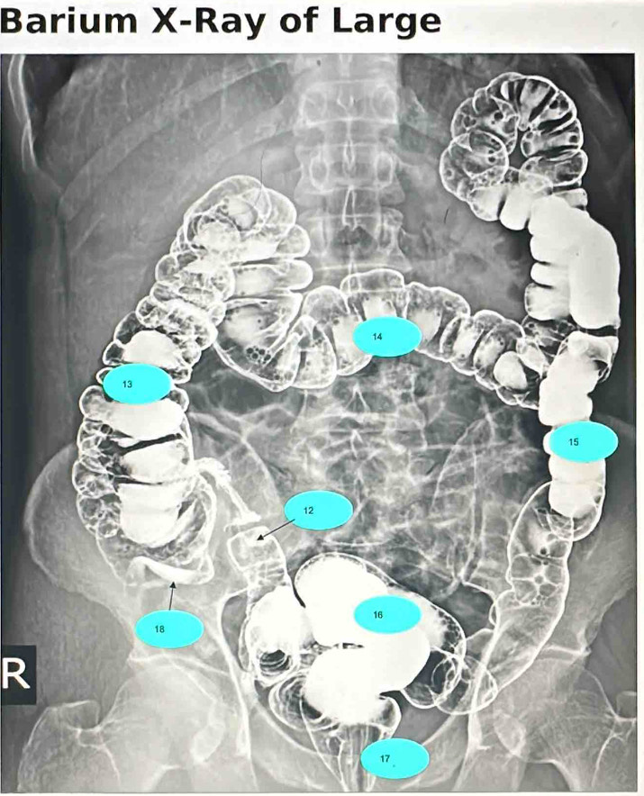 Barium X -Ray of Large 
R
17