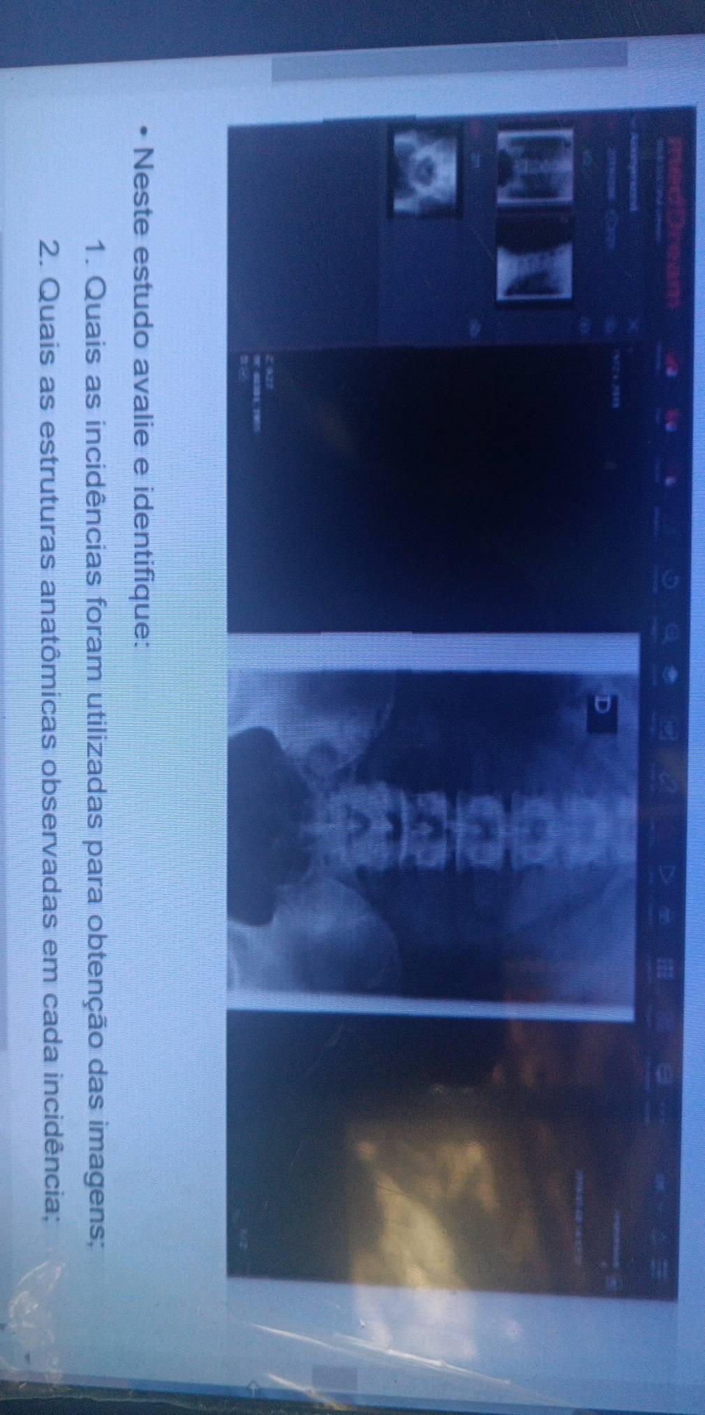 Neste estudo avalie e identifique: 
1. Quais as incidências foram utilizadas para obtenção das imagens; 
2. Quais as estruturas anatômicas observadas em cada incidência;