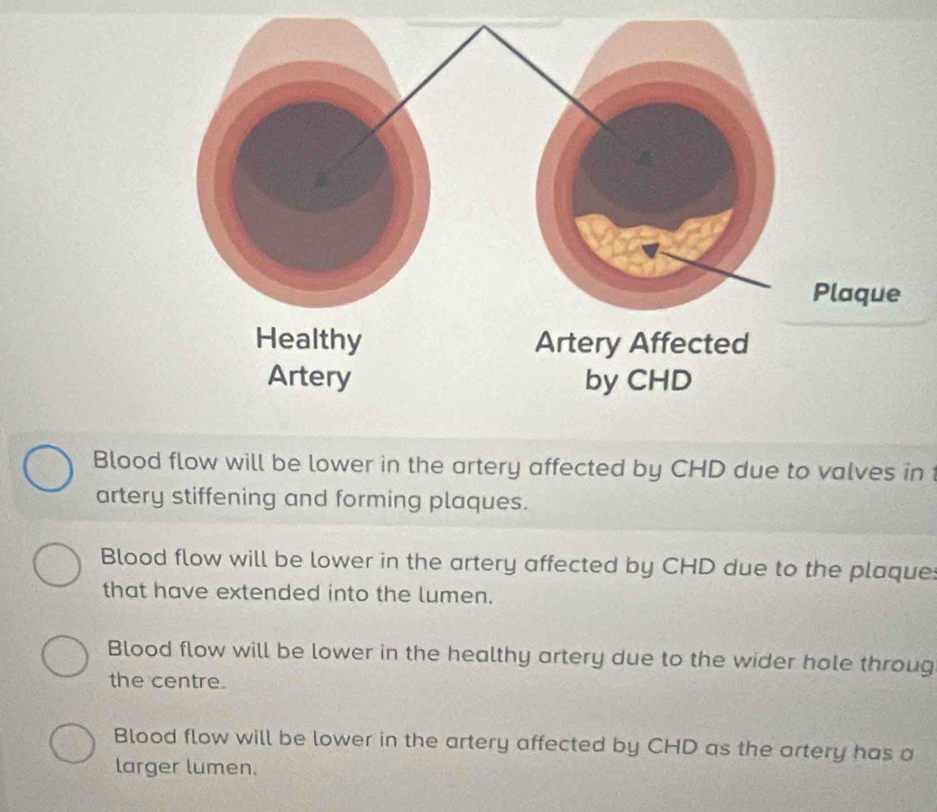 Blood flow will be lower in the artery affected by CHD due to valves in 
artery stiffening and forming plaques.
Blood flow will be lower in the artery affected by CHD due to the plaque
that have extended into the lumen.
Blood flow will be lower in the healthy artery due to the wider hole throug
the centre.
Blood flow will be lower in the artery affected by CHD as the artery has a
larger lumen.