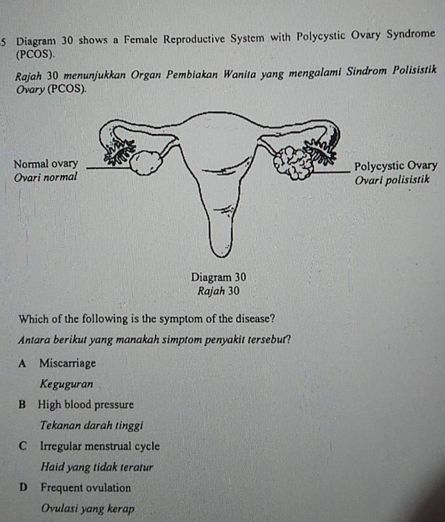 Diagram 30 shows a Female Reproductive System with Polycystic Ovary Syndrome
(PCOS).
Rajah 30 menunjukkan Organ Pembiakan Wanita yang mengalami Sindrom Polisistik
Ovary (PCOS).
y
Which of the following is the symptom of the disease?
Antara berikut yang manakah simptom penyakit tersebut?
A Miscarriage
Keguguran
B High blood pressure
Tekanan darah tinggi
C Irregular menstrual cycle
Haid yang tidak teratur
D Frequent ovulation
Ovulasi yang kerap