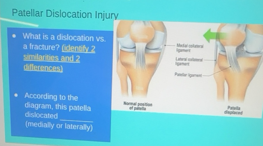 Solved: Patellar Dislocation Injury What is a dislocation vs a fracture ...