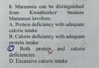 Marasmus can be distinguished
from Kwashiorkor because
Marasmus involves:
A. Protein deficiency with adequate
calorie intake
B. Calorie deficiency with adequate
protein intake
Both protein and calorie
deficiencies
D. Excessive calorie intake