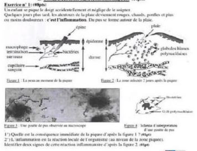 Esercice n°' 1 : (98pts) 
Un exfant se piqre le doigt accidentellement et néglipe de le soigner 
Quelques jours pla tard, les alentours de la plaie dévienaent roupes, clauds, ponfles et plus 
ou moins douloureus : c'est l'inflamnation. Du pus se forme autour de la plaie. 
épine plale 
épidenne 
macrophage glabales hlones 
letrlna lson Chacséries polynuciêsises 
=ers do ve 
capilaire S 
sang in 
Erat 1: La pesa au moment de la piqure Eippr:2 : La sone alistée 2 jnes apès la papte 
Tockfries 
O.J poty=uN/aies 
Figste 3 : Une poutte de pus oservée au mactoncope Figury 4 Sclontia d'interprnátion 
É'uue rontie de rus 
l '') Quelle est la conséquence immédiate de la piqure d'apsès la figure 1 7 (914es 
* ') L inflammation est la réaction locale de L'organisme (au mveas de la zone psquée). 
Identifier desx signes de cette réaction inflammatoire d'sprès la figure 2, 1tg4