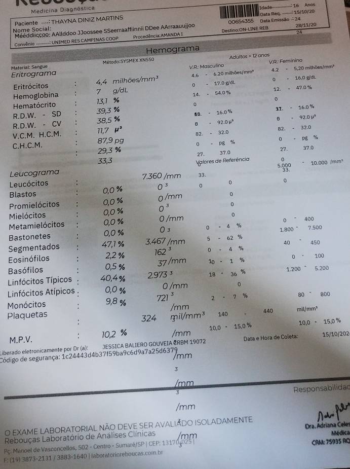 Medicina Diagnóstica
Paciente ..··: THAYNA DINIZ MARTINS Idade = 16 Anos
Nome Social: 00654355 Data Emissão  24 l Data Req. .....⋅⋅ 15/10/20
Mééddiicçoo: AAllddoo JJoossee SSeerraaffiinnii DDee AArraauujjoo 2B/11/20
24
Convênio ---------- UNIMED RES CAMPINAS COOP Procedência:AMANDA I Destino:ON-LINE REB
Hemograma
Material: Sangue Método:SYSMEX XNS50 Adultos > 12 anos
V.R.: Masculino
Eritrograma V.R: Feminino
Eritrócitos    4,4 milhões/ mm^3 4.6 - 6.20 milhões/mm² 4.2 5,20 milhões/mm²
Hemoglobina 7 g/dL 0 - 17.0 g/dl 0 -16,0 g/di
12. -47.0°
Hematócrito 13,1 % 14. 54.0%
16.0 %6
R.D.W. - SD 39,3 % 0
R.D.W. - CV 38,5 % . - 16.0 % 37.
82. - 32.0
V.C.M. H.C.M. 11,7 mu^3 θ . 92.0mu^5 B . 92.0mu^3
C.H.C.M. 87,9 pg 82. - 32.0
29,3 % 0 - pg % 0 . P %
27 -
27. 37.0 37.0
Valores de Referência 0
33,3 5.000 10.000/mm^3
Leucograma
Leucócitos 7,360 /mm 33. 33
0,0 % O^3 0 0 0
Blastos 0
Promielócitos 0,0 % 0/mm
Mielócitos 0,0 % O^3
0
0 400
Metamielócitos 0,0 % 0/mm 0
Bastonetes 0,0 % 0 3 0 - 4 % 1.800 7.500
40 450
Segmentados 47,1 % 3.467 /mm 5 - 62 %
Eosinófilos 162^3 0 - 4 %
2,2 %
Basófilos 0,5 % 37/mm 10 - 1 % 0 100
Linfócitos Típicos 40,4% 2.973^3 18  36 1.200 5.200
Linfócitos Atípicos 0,0 % 0 /mm 0
Monócitos 9,8 % 721^3 % 80 800
Plaquetas /mm mil/mm³
324
. mil/m m^3 140
440
M.P.V. : 10,2 % /mm 10.0-15.0% 10,0 - 15.0 %
Liberado eletronicamente por Dr (a): JESSICA BALIERO GOUVEIA CRBM 19072  Data e Hora de Coleta: 15/10/202
Código de segurança: 1c24443d4b37f59ba9c6d9a7a25d6379 /mm
3
/mm
3
Responsabilidad
/mm
O eXAme LABORATORIAl não deve sEr avaliÃdo iSolADAMENTE
Rebouças Laboratório de Análises Clínicas /mm Dra, Adriana Čeles
ç. Manoel de Vasconcellos, 502 - Centro - Sumaré/SP | CEP: 131704025 | Médica
F: (19) 3873-2131 / 3883-1640 | laboratorioreboucas.com.br CAM: 75935 RQ