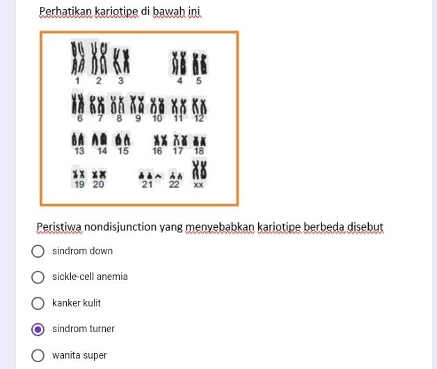 Perhatikan kariotipe di bawah ini
Peristiwa nondisjunction yang menyebabkan kariotipe berbeda disebut
sindrom down
sickle-cell anemia
kanker kulit
sindrom turner
wanita super