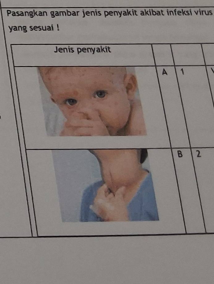 Pasangkan gambar jenis penyakit akibat infeksi virus
yang sesuai !
Jenis penyakit
A 1 、
B 2