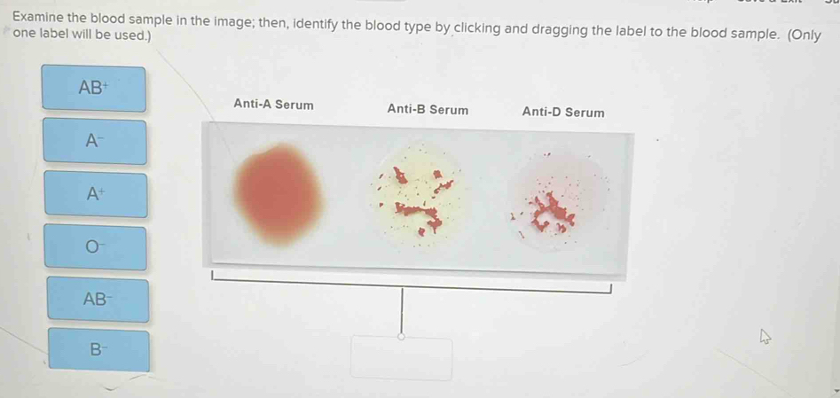 Solved: Examine the blood sample in the image; then, identify the blood ...