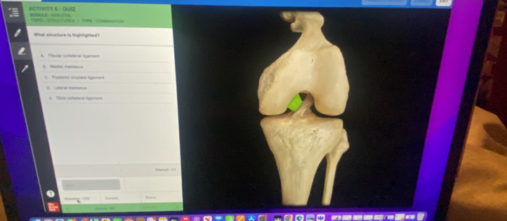 9=GM30°
ACTIVITY 
TOPIC : STRUCTURES / TYPE : COMBMATION
What structure is highlighted?
A. Fibular collateral ligament
I. Medial meniscus
ostartra cruniata lram ar
Latera mamacu
Tilsal collsteral ligámer
Atensh 1/1