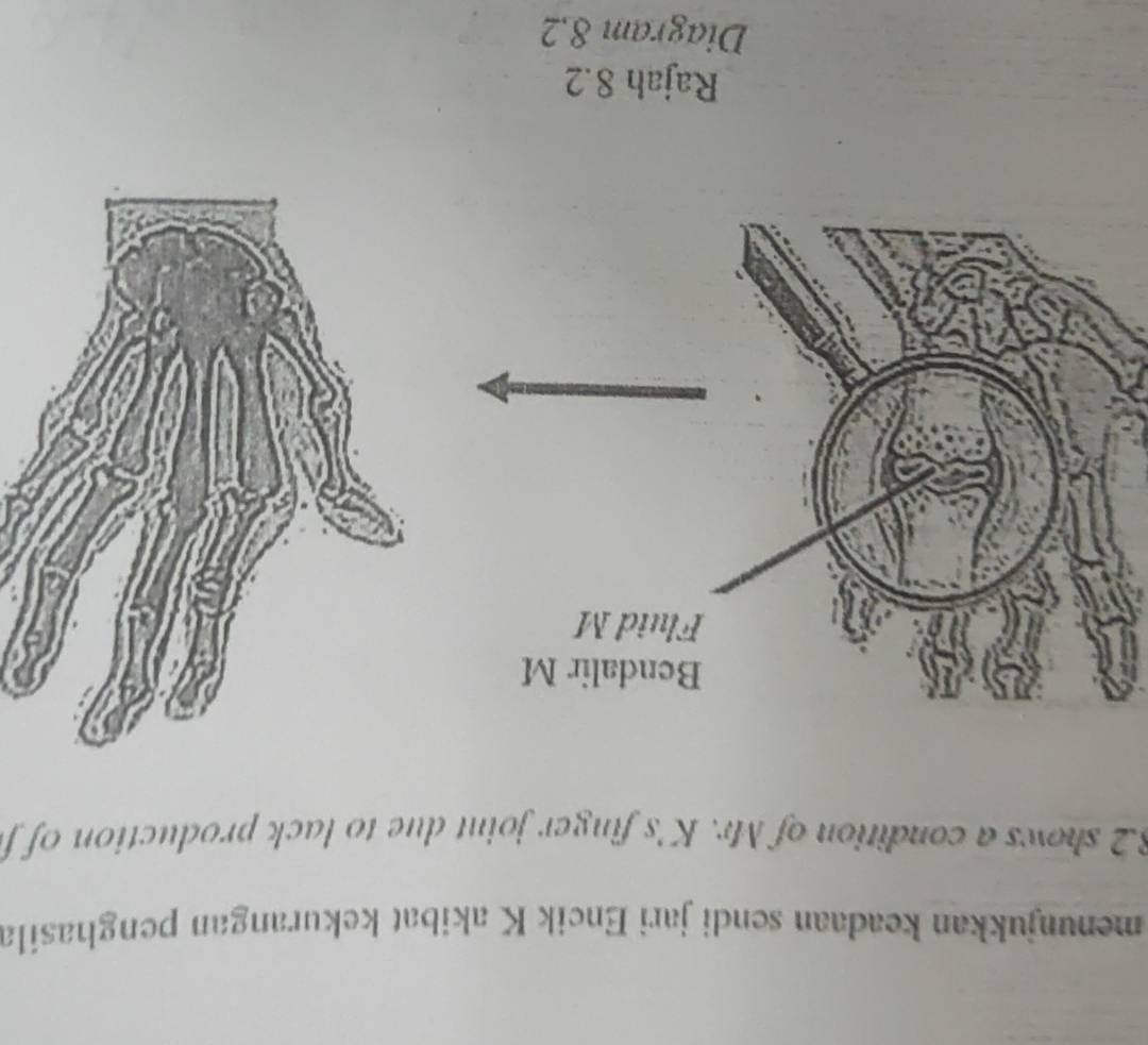 menunjukkan keadaan sendi jari Encik K akibat kekurangan penghasila
8.2 shows a condition of Mr. K's finger joint due to lack production of f 
Rajah 8.2 
Diagram 8,2