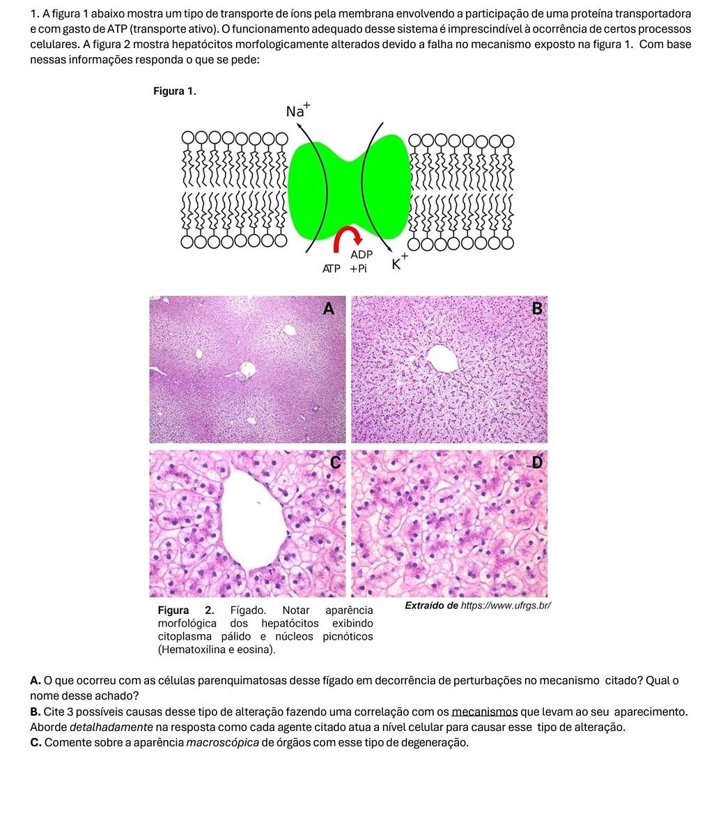 A figura 1 abaixo mostra um tipo de transporte de íons pela membrana envolvendo a participação de uma proteína transportadora 
e com gasto de ATP (transporte ativo). O funcionamento adequado desse sistema é imprescindível à ocorrência de certos processos 
celulares. A figura 2 mostra hepatócitos morfologicamente alterados devido a falha no mecanismo exposto na figura 1. Com base 
nessas informações responda o que se pede: 
Figura 1. 
A. O que ocorreu com as células parenquimatosas desse fígado em decorrência de perturbações no mecanismo citado? Qual o 
nome desse achado? 
B. Cite 3 possíveis causas desse tipo de alteração fazendo uma correlação com os mecanismos que levam ao seu aparecimento. 
Aborde detalhadamente na resposta como cada agente citado atua a nível celular para causar esse tipo de alteração. 
C. Comente sobre a aparência macroscópica de órgãos com esse tipo de degeneração.