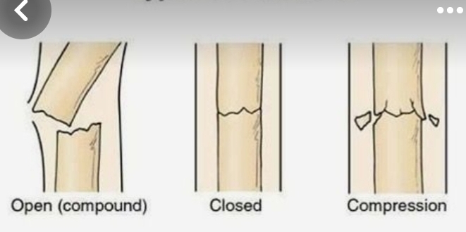 Open (compound) Closed Compression