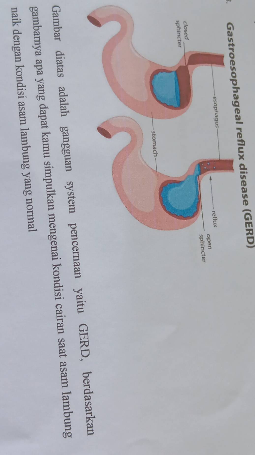 eflux disease (GERD) 
Gambar diatas adalah gangguan system pencernaan yaitu GERD, berdasarkan 
gambarnya apa yang dapat kamu simpulkan mengenai kondisi cairan saat asam lambung 
naik dengan kondisi asam lambung yang normal