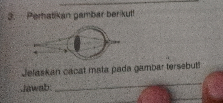 Perhatikan gambar berikut! 
Jelaskan cacat mata pada gambar tersebut! 
Jawab: 
_ 
_