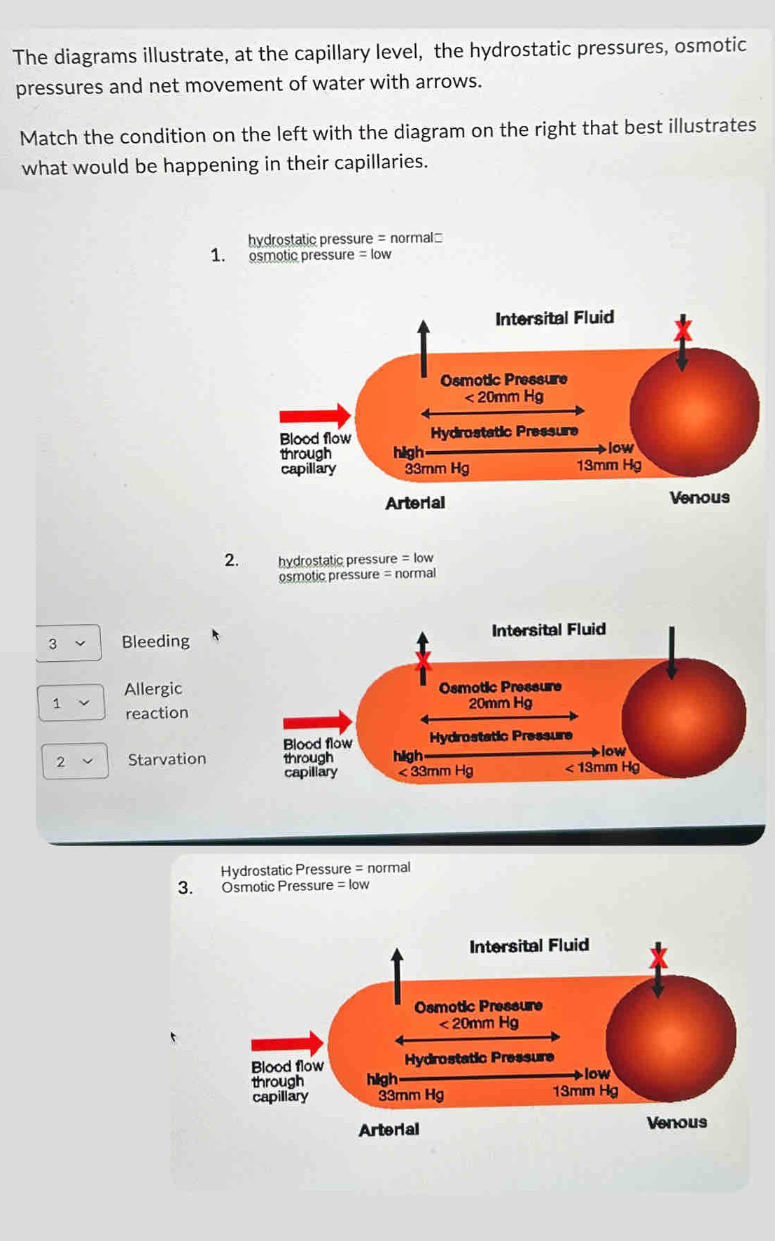 The diagrams illustrate, at the capillary level, the hydrostatic pressures, osmotic
pressures and net movement of water with arrows.
Match the condition on the left with the diagram on the right that best illustrates
what would be happening in their capillaries.
hydrostatic pressure = normal=
1. osmotic pressure = low
2. hydrostatic pressure = low
osmotic pressure = normal
3 Bleeding
Allergic
1 reaction
2 Starvation
Hydrostatic Pressure = normal
3. Osmotic Pressure = low