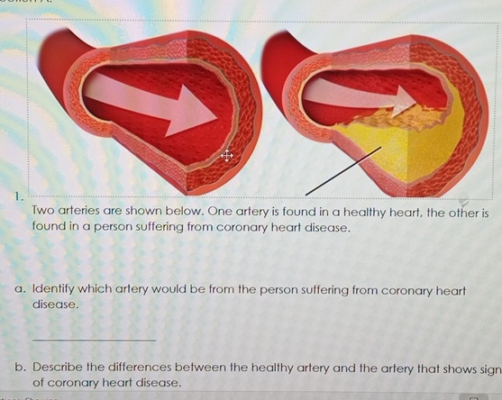 Two arteries are shown below. One artery is found in a healthy heart, the other is 
found in a person suffering from coronary heart disease. 
a. Identify which artery would be from the person suffering from coronary heart 
disease. 
_ 
b. Describe the differences between the healthy artery and the artery that shows sign 
of coronary heart disease.