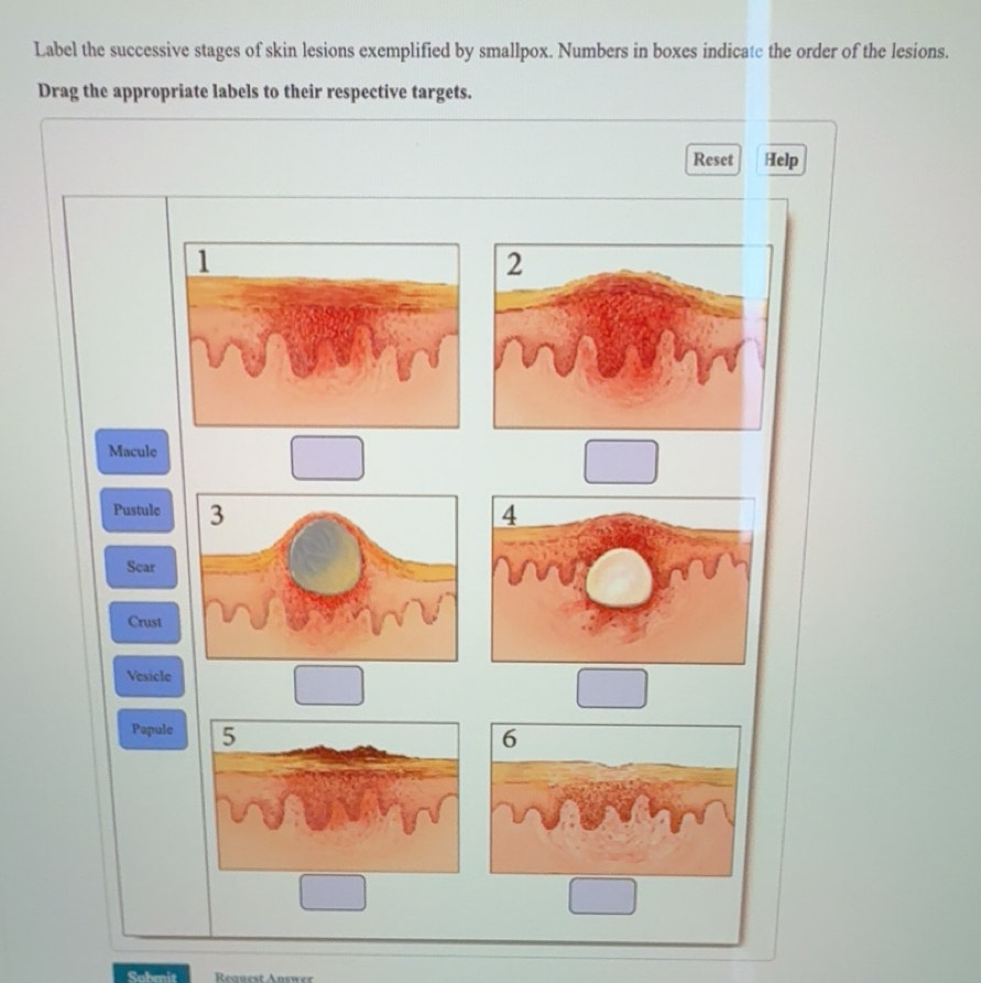 Solved: Label the successive stages of skin lesions exemplified by ...