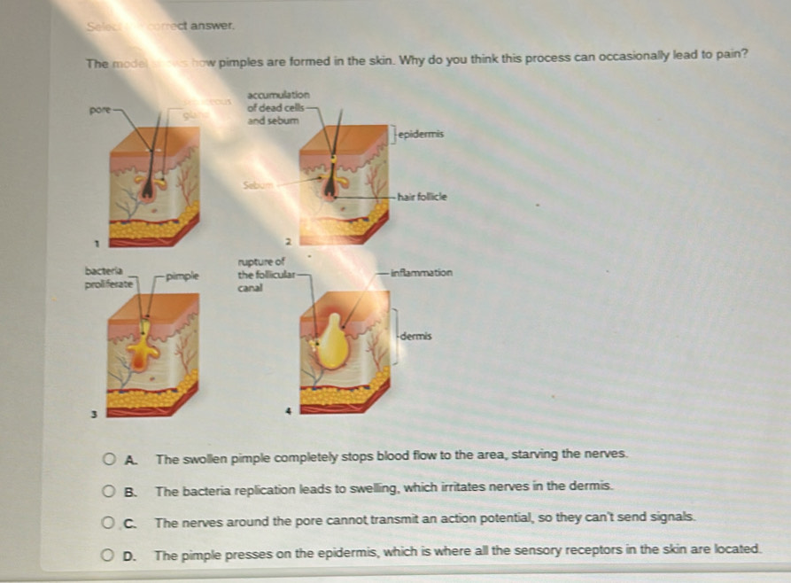 Solved: Select correct answer. The model sows how pimples are formed in ...