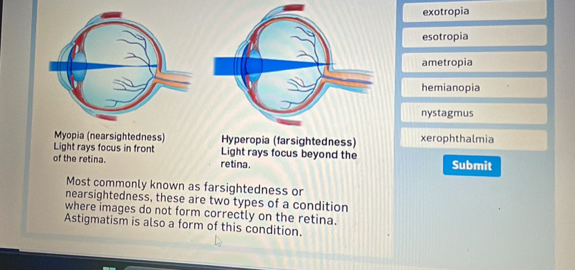 exotropia
esotropia
ametropia
hemianopia
nystagmus
Myopia (nearsightedness) Hyperopia (farsightedness) xerophthalmia
Light rays focus in front Light rays focus beyond the
of the retina. retina. Submit
Most commonly known as farsightedness or
nearsightedness, these are two types of a condition
where images do not form correctly on the retina.
Astigmatism is also a form of this condition.