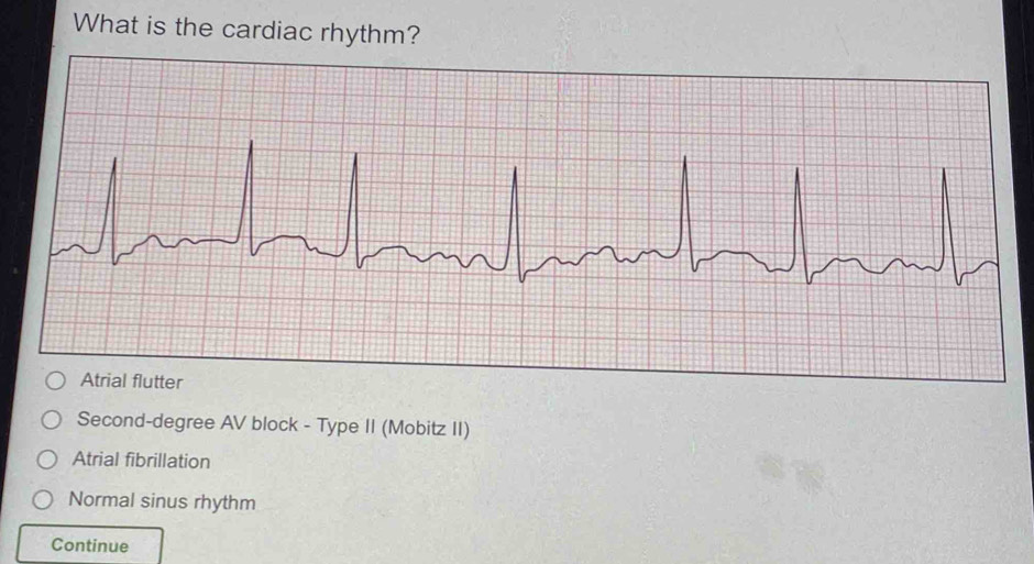 Solved: What is the cardiac rhythm? Atrial flutter Second-degree AV ...