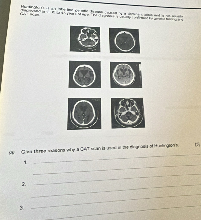 Huntington's is an inherited genetic disease caused by a dominant allele and is not usually 
CAT scan. 
diagnosed until 35 to 45 years of age. The diagnosis is usually confirmed by genetic testing and 
(a) Give three reasons why a CAT scan is used in the diagnosis of Huntington's. [3] 
_ 
1. 
_ 
2._ 
_ 
3. 
_ 
_