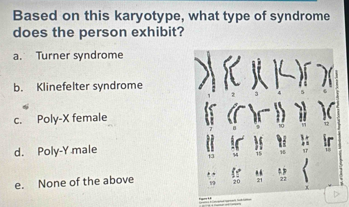 Based on this karyotype, what type of syndrome
does the person exhibit?
a. Turner syndrome
b. Klinefelter syndrome
2
c. Poly- X female
2
d. Poly- Y male
13 14 15 16 18
e. None of the above
19 t
21 22
x
Cantetire & Cancrphcal Agermach Sorth Edlition Figure 48