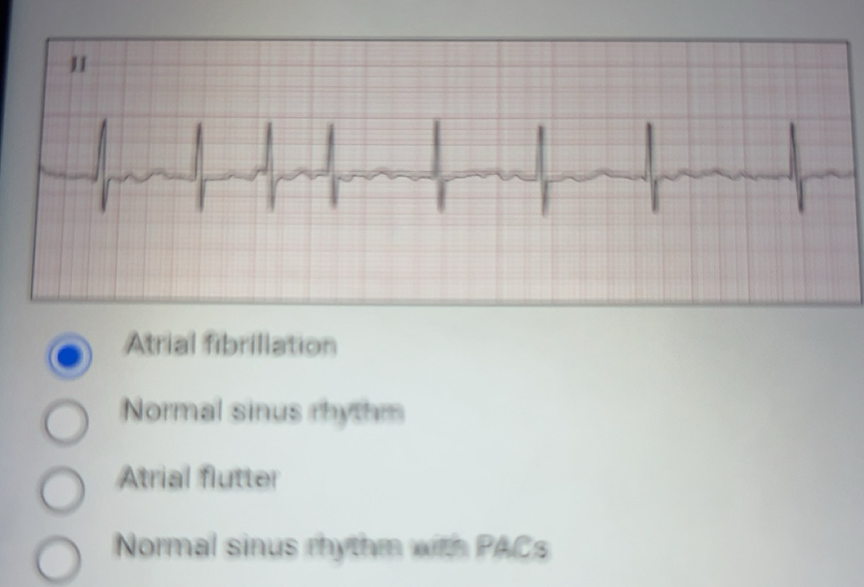 Solved: Atrial fibrillation Normal sinus rhythm Atrial flutter Normal ...