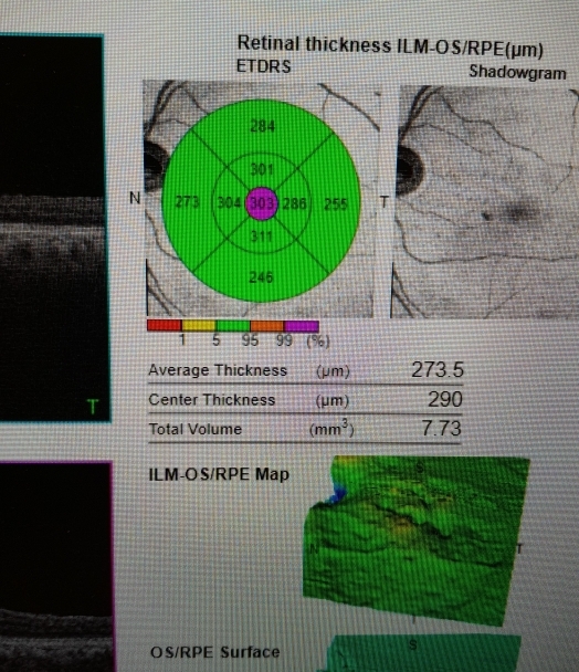 Solved: Retinal thickness ILM-OS/RPE(μm) ETDRS Shadowgram T ILM-O S/RPE ...