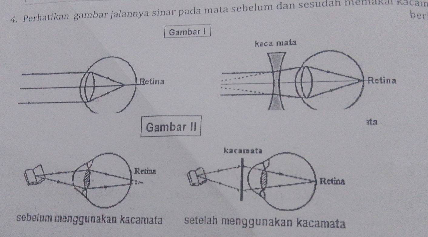 Perhatikan gambar jalannya sinar pada mata sebelum dan sesudah memakaı kacam 
ber 
Gambar I 
Retina 
Gambar II 
sebelum menggunakan kacamata setelah menggunakan kacamata