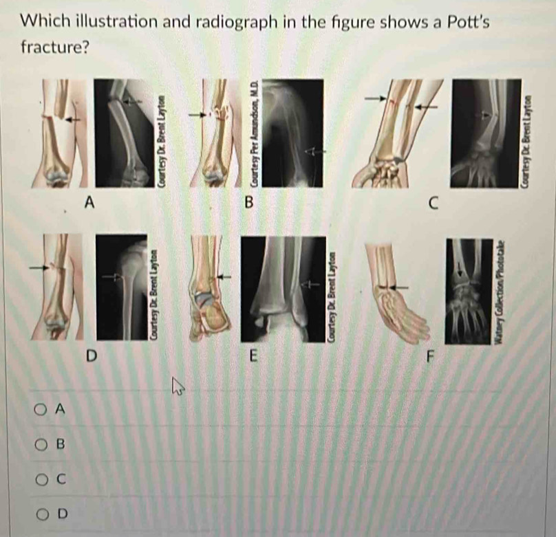 Solved: Which illustration and radiograph in the figure shows a Pott's ...