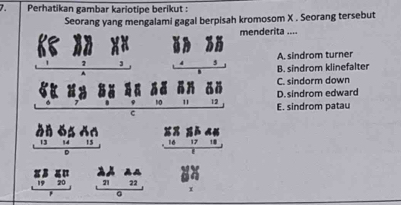 Perhatikan gambar kariotipe berikut :
Seorang yang mengalami gagal berpisah kromosom X . Seorang tersebut
menderita ....
A. sindrom turner
5 B. sindrom klinefalter
C. sindorm down
D.sindrom edward
7 10 11 12 E. sindrom patau
c
beginarrayr bib 131415 hline endarray beginarrayr 888648161718 hline endarray
beginarrayr beginarrayr 2,beginarrayr 2.4 _ 212 0endarray  x