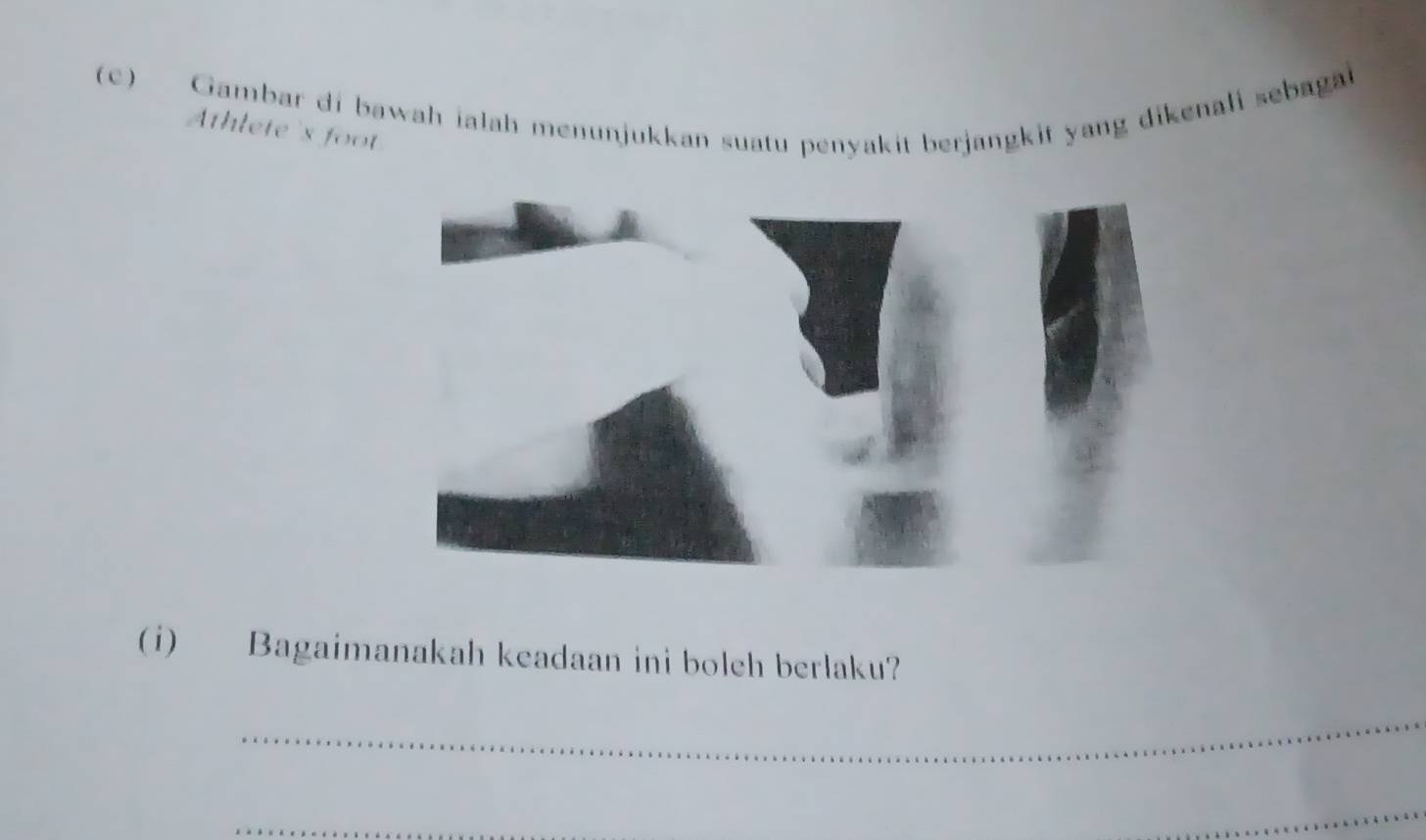 Gambar di bawah ialah menunjukkan suatu penyakit berjangkit yang dikenali sebagai 
Athlete 's foot 
(i) Bagaimanakah keadaan ini boleh berlaku? 
_ 
_ 
_