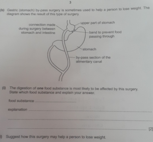 3
(b) Gastric (stomach) by-pass surgery is sometimes used to help a person to lose weight. The
diagram shows the result of this type of surgery.
connection made upper part of stomach
during surgery between
stomach and intestine band to prevent food
passing through
stomach
by-pass section of the
alimentary canal
(1) The digestion of one food substance is most likely to be affected by this surgery.
State which food substance and explain your answer.
food substance_
explanation_
_
_[2]
) Suggest how this surgery may help a person to lose weight.