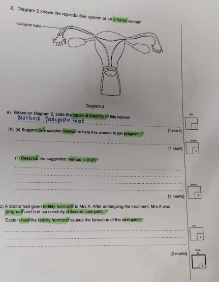 Diagram 2 shows the reproductive sy 
Diagram 2 
_ 
a) Based on Diagram 2, state the cause of infertility of this woman 

(b) (ii) Suggest one suitable method to help this woman to get pregnant [1 mark] 
_ 
2N00 
[1 mark) 
(ii) Describe the suggested methad in (b)(i) 
_ 
_ 
_ 
_ 
[3 marks] 
c) A doctor had given fertility hormone to Mrs A. After undergoing the treatment, Mrs A was 
pregnant and had successfully delivered sextuplets. 
Explain how the fertility hormone causes the formation of the sextuplets, 
_ 
_ 
_ 
[2 marks] Ystal