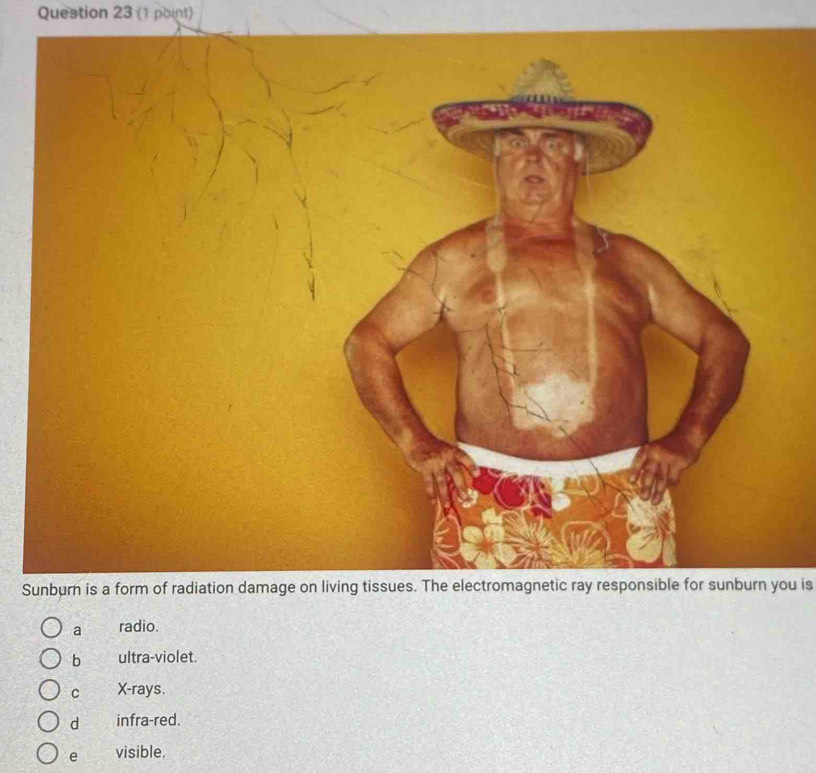 Sunburn is a form of radiation damage on living tissues. The electromagnetic ray responsible for sunburn you is
a radio.
b ultra-violet.
C X -rays.
d infra-red.
e visible.