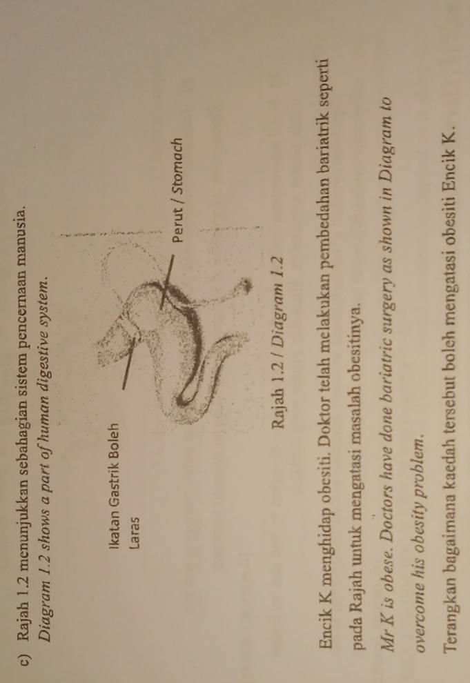 Rajah 1.2 menunjukkan sebahagian sistem pencernaan manusia. 
Diagram 1.2 shows a part of human digestive system. 
Encik K menghidap obesiti. Doktor telah melakukan pembedahan bariatrik seperti 
pada Rajah untuk mengatasi masalah obesitinya. 
Mr K is obese. Doctors have done bariatric surgery as shown in Diagram to 
overcome his obesity problem. 
Terangkan bagaimana kaedah tersebut boleh mengatasi obesiti Encik K.