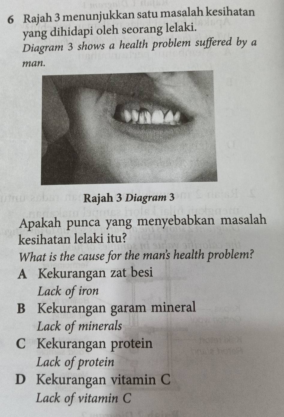 Rajah 3 menunjukkan satu masalah kesihatan
yang dihidapi oleh seorang lelaki.
Diagram 3 shows a health problem suffered by a
man.
Rajah 3 Diagram 3
Apakah punca yang menyebabkan masalah
kesihatan lelaki itu?
What is the cause for the mans health problem?
A Kekurangan zat besi
Lack of iron
B Kekurangan garam mineral
Lack of minerals
C Kekurangan protein
Lack of protein
D Kekurangan vitamin C
Lack of vitamin C