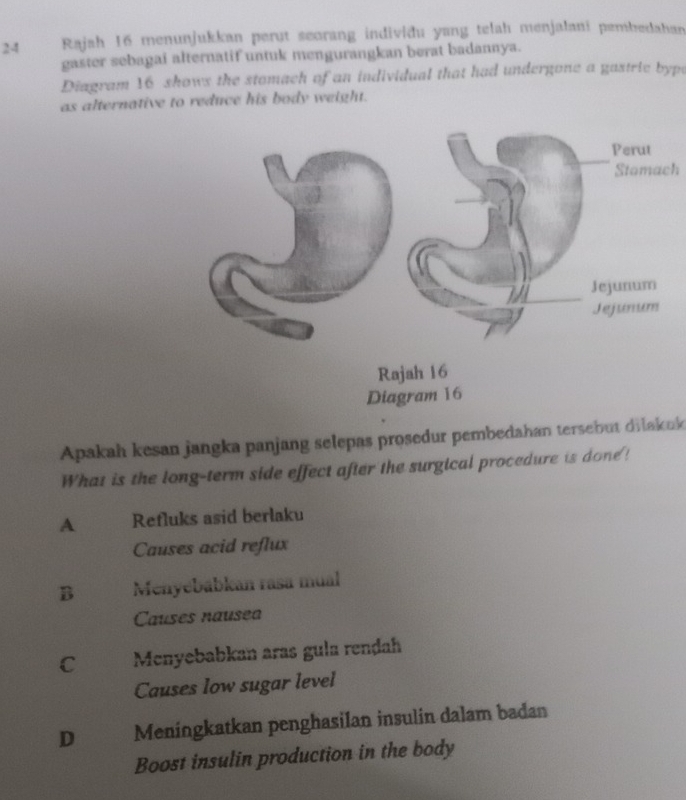 Rajah 16 menunjukkan perut seorang indiviðu yang telah menjalani pembedahan
gaster sebagai alternatif untuk mengurangkan berat badannya.
Diagram 16 shows the stomach of an individual that had undergone a gastric bype
as alternative to reduce his body weight.
Stomach
Apakah kesan jangka panjang selepas prosedur pembedahan tersebut dilakuk
What is the long-term side effect after the surgical procedure is done!
A Refluks asid berlaku
Causes acid reflux
B Menyebábkan rasa mual
Causes nausea
C Menyebabkan aras gula renḍah
Causes low sugar level
D Meningkatkan penghasilan insulin dalam badan
Boost insulin production in the body