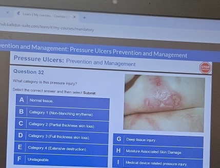 × Learn ] My courses - Courses I
hub.kallidus-suite.com/lear/#/my-courses/mandatory
vention and Management: Pressure Ulcers Prevention and Management
Pressure Ulcers: Prevention and Management
Question 32
What category is this pressure injury?
Select the correct answer and then select Submit.
Normal tissue.
Category 1 (Non-blanching erythema)
Category 2 (Partial thickness skin loss)
Category 3 (Full thickness skin loss) C Deep tissue injury
Category 4 (Extensive destruction) Moisture Associated Skin Damage.
Unstagoable. Medical device related pressure injury