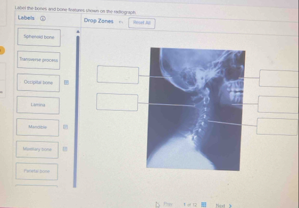 Solved: Label the bones and bone features shown on the radiograph ...