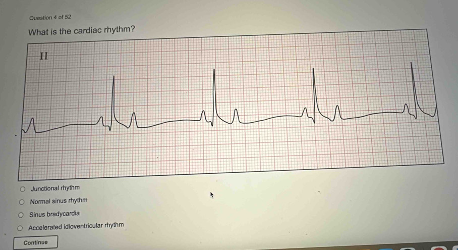 rhythm?
Junctional rhythm
Normal sinus rhythm
Sinus bradycardia
Accelerated idioventricular rhythm
Continue