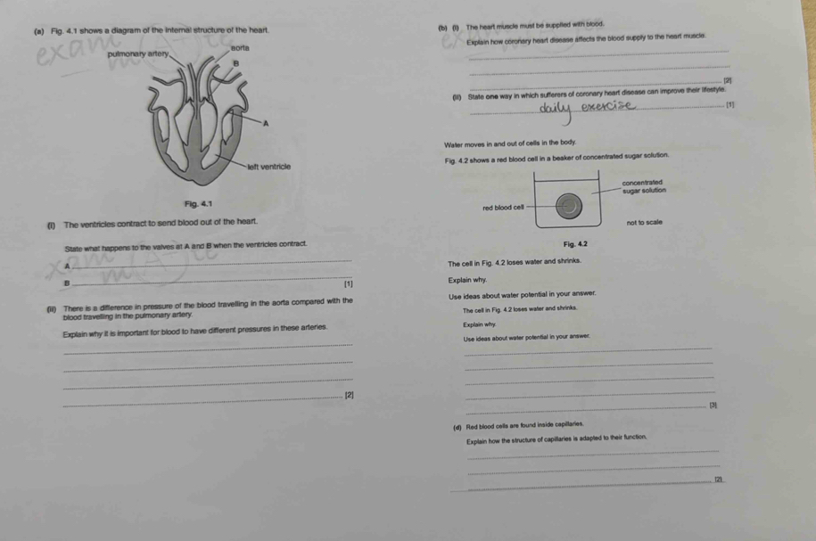 Fig. 4.1 shows a diagram of the internal structure of the heart (b)(l) The heart muscle must be suppfied with blood. 
Explain how coronary heart disease affects the blood supply to the heart muscle. 
_ 
_. [2] 
(11) State one way in which sufferers of coronary heart disease can improve their lifestyle 
_[1] 
Water moves in and out of cells in the body. 
Fig. 4.2 shows a red blood cell in a beaker of concentrated sugar sclution. 
(1) The ventricles contract to send blood out of the heart. 
State what happens to the valves at A and B when the ventricles contract. 
A 
_The cell in Fig. 4.2 loses water and shrinks. 
B 
_ 
[1] Explain why. 
(ii) There is a difference in pressure of the blood travelling in the aorta compared with the Use ideas about water potential in your answer. 
blood travelling in the pulmonary artery. The cell in Fig. 4.2 loses water and shrinks. 
Explain why it is important for blood to have different pressures in these arteries. Explain why 
_ 
_ 
Use ideas about water potential in your answer. 
_ 
_ 
_ 
_ 
_. [2] 
_ 
_3 
(d) Red blood cells are found inside capiltaries. 
_ 
Explain how the structure of capillaries is adapted to their function. 
_ 
_121