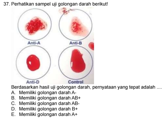 Perhatikan sampel uji golongan darah berikut!
Berdasarkan hasil uji golongan darah, pernyataan yang tepat adalah ....
A. Memiliki golongan darah A -
B. Memiliki golongan darah AB+
C. Memiliki golongan darah AB -
D. Memiliki golongan darah B+
E. Memiliki golongan darah A+