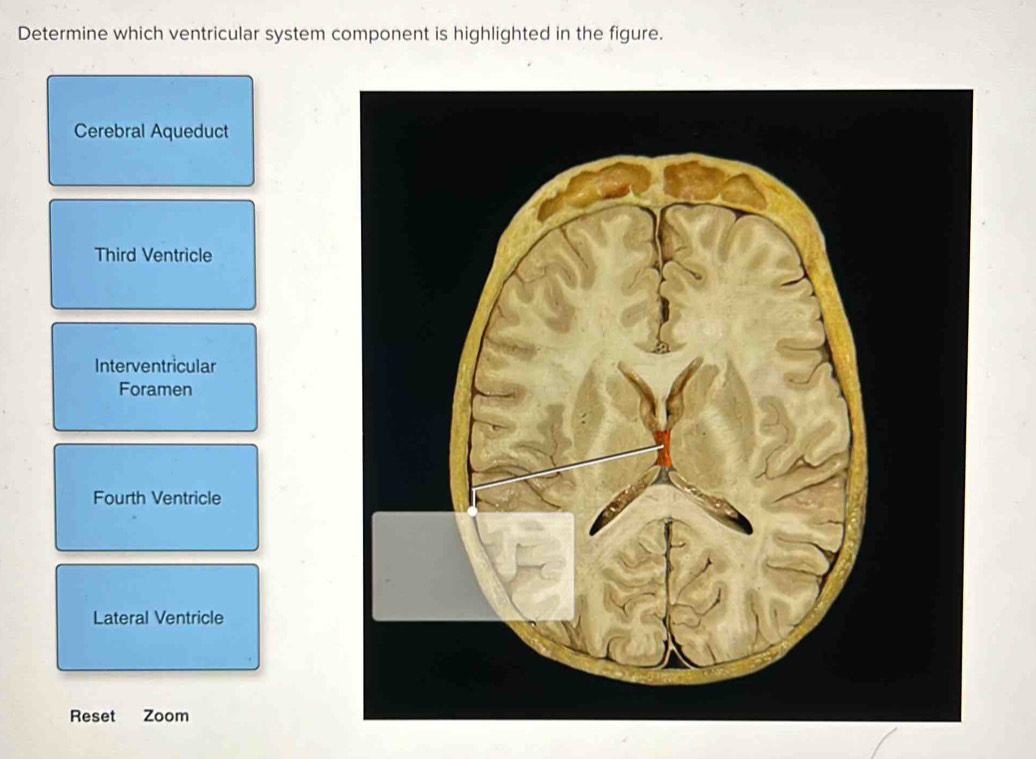 Solved: Determine which ventricular system component is highlighted in ...