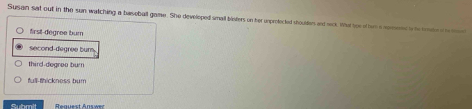 Susan sat out in the sun watching a baseball game. She developed small blisters on her unprotected shoulders and neck. What type of burn is represented by the foration of be trmn
first-degree burn
second-degree burn
third-degree burn
full-thickness burn
Submit Request Answer