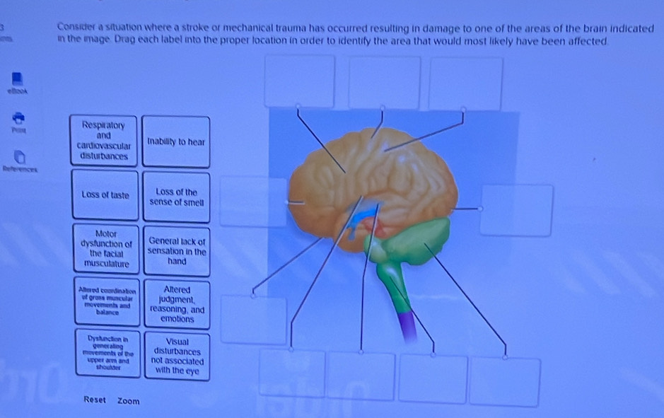 Consider a situation where a stroke or mechanical trauma has occurred resulting in damage to one of the areas of the brain indicated 
in the image. Drag each label into the proper location in order to identify the area that would most likely have been affected.
20A
A Respiratory 
and 
cardiovascular Inability to hear 
disturbances 
References 
Loss of the 
Loss of taste sense of smell 
Motor General lack of 
dysfunction of sensation in the 
the facial 
musculature hand 
Altered coordination Altered 
of grose muscular judgment. 
movements and reasoning, and 
balance emotions 
Dysfunction in Visual 
generating disturbances 
movements of the upper arm and not associated 
shoulder with the eye 
Reset Zoom