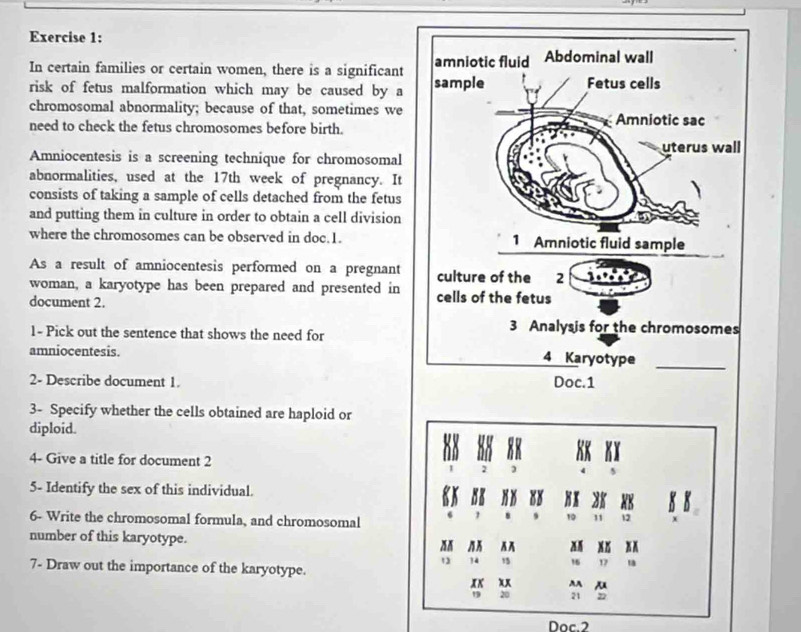 In certain families or certain women, there is a significant amniotic fluid Abdominal wall 
risk of fetus malformation which may be caused by a sample Fetus cells 
chromosomal abnormality; because of that, sometimes we Amniotic sac 
need to check the fetus chromosomes before birth. 
uterus wall 
Amniocentesis is a screening technique for chromosomal 
abnormalities, used at the 17th week of pregnancy. It 
consists of taking a sample of cells detached from the fetus 
and putting them in culture in order to obtain a cell division 
where the chromosomes can be observed in doc.1. 1 Amniotic fluid sample 
As a result of amniocentesis performed on a pregnant 
woman, a karyotype has been prepared and presented in culture of the 2
document 2. cells of the fetus 
1- Pick out the sentence that shows the need for 
3 Analysis for the chromosomes 
amniocentesis. 4 Karyotype_ 
2- Describe document 1. Doc.1 
3- Specify whether the cells obtained are haploid or 
diploid. 
4- Give a title for document 2
2 
5- Identify the sex of this individual. 
NK 88 Hx 88 88 K K 
6- Write the chromosomal formula, and chromosomal 
1 10 11 12
number of this karyotype. 
AA M
12 14 15 16 1
7- Draw out the importance of the karyotype. 
xx xx AA
19 20 21 22
Doc.2