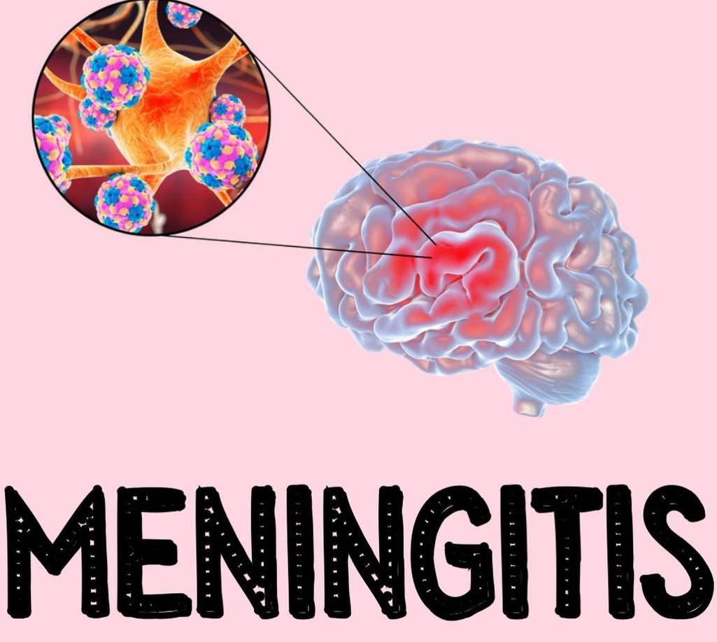 MENINGITIS