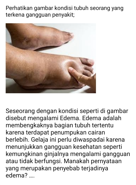 Perhatikan gambar kondisi tubuh seorang yang 
terkena gangguan penyakit; 
Seseorang dengan kondisi seperti di gambar 
disebut mengalami Edema. Edema adalah 
membengkaknya bagian tubuh tertentu 
karena terdapat penumpukan cairan 
berlebih. Gelaja ini perlu diwaspadai karena 
menunjukkan gangguan kesehatan seperti 
kemungkinan ginjalnya mengalami gangguan 
atau tidak berfungsi. Manakah pernyataan 
yang merupakan penyebab terjadinya 
edema? ....